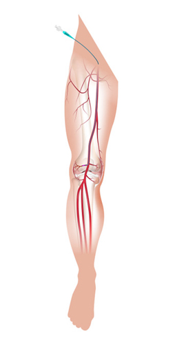 Diagram of knee embolism showing blocked blood vessels in the knee joint, with emphasis on swelling and pain